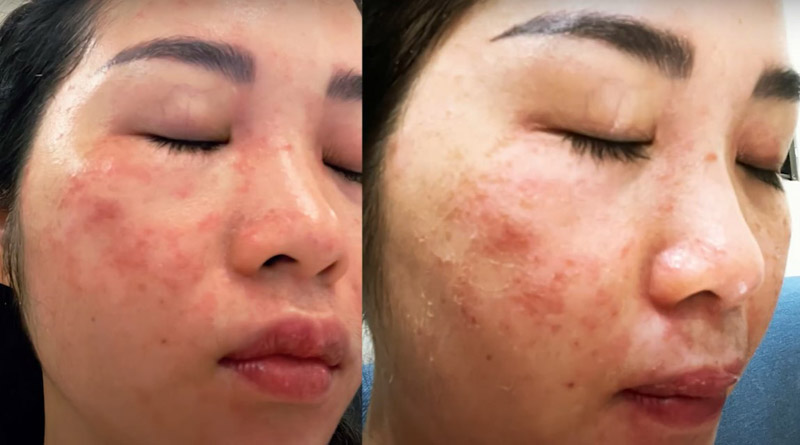 Da tổn thương do dùng laser sai cách