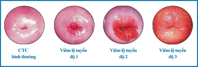 Viêm lộ tuyến độ 1 là tình trạng viêm nhẹ của bệnh