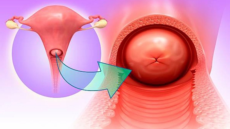 Viêm lộ tuyến 1cm không gây nguy hiểm nhưng vẫn cần điều trị sớm