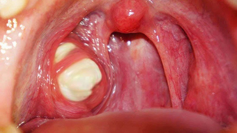 Viêm amidan có thể gây gây ra nhiều biến chứng nguy hiểm