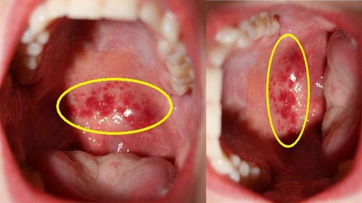 Viêm Họng Hạt: Nguyên Nhân, Dấu Hiệu Nhận Biết Và Cách Chữa