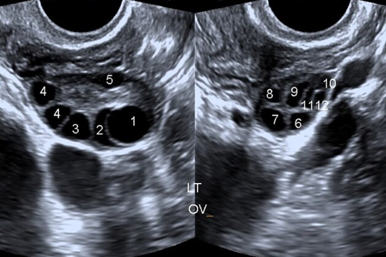 Hình ảnh siêu âm buồng trứng đa nang